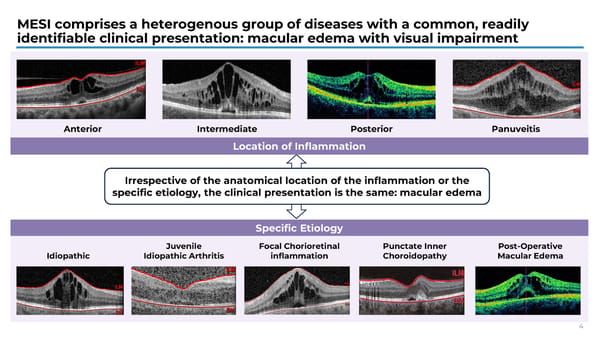 APEX Study Phase 1b Results on KSI-101 for Macular Edema - Page 4